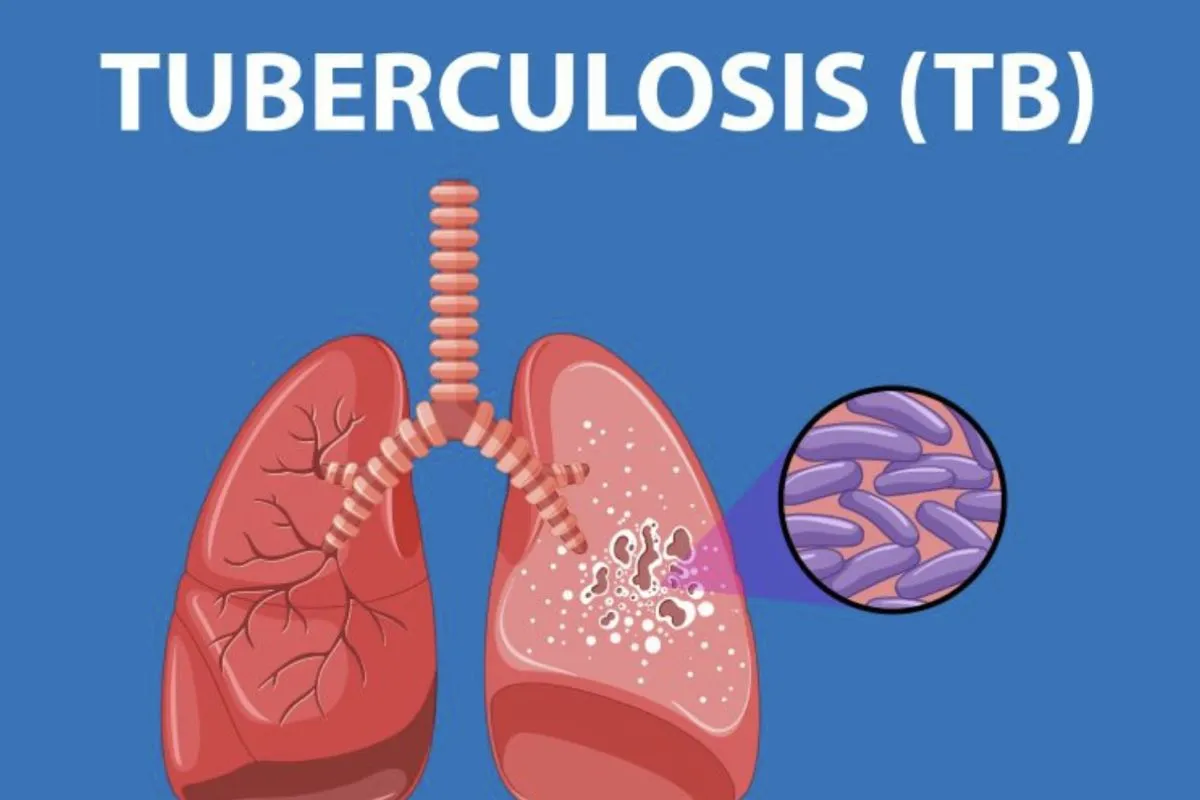 Menarik nafas tanpa takut tuberkulosis di 2030