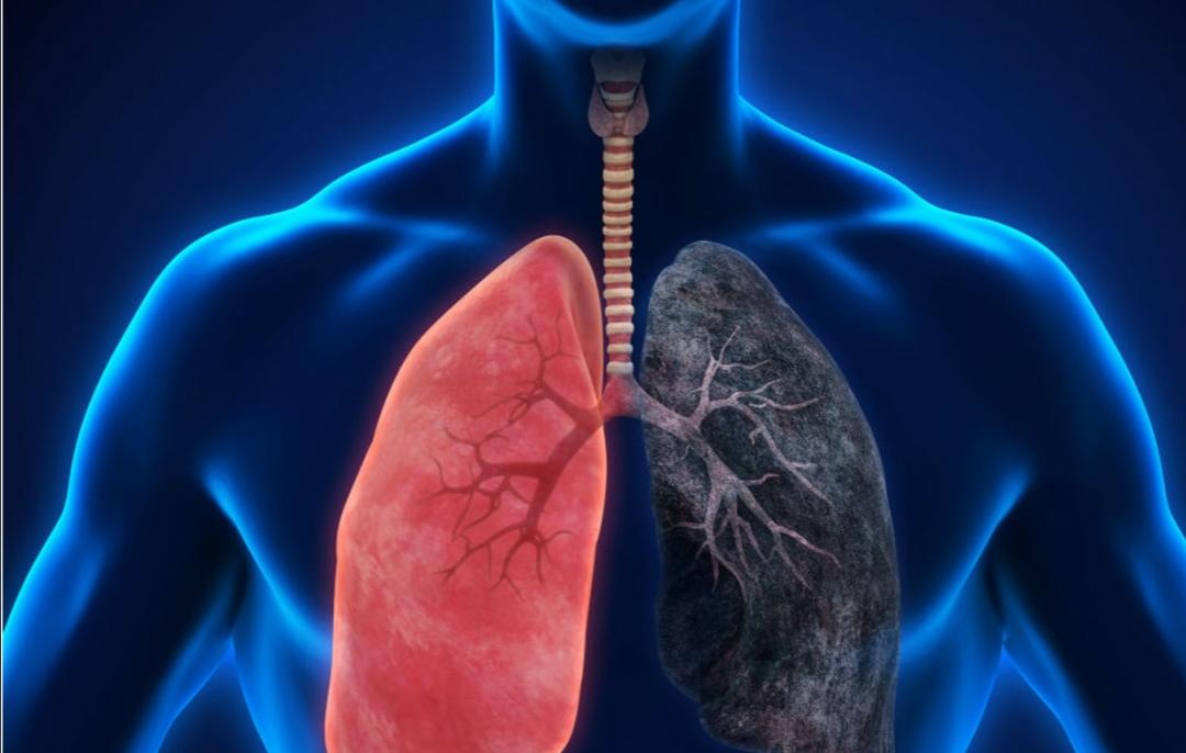 ISPA VS Pneumonia : Kenali Perbedaannya
